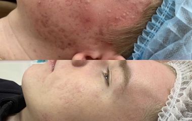 Як вилікувати акне